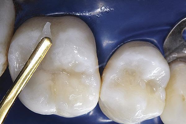 Как выбрать правильный адгезив для реставраций дистальных зубов?