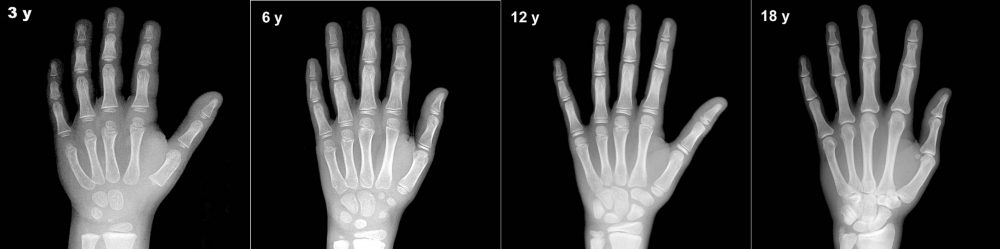 The difference in length of hand bones in children aged 3, 6, 12, and 18 